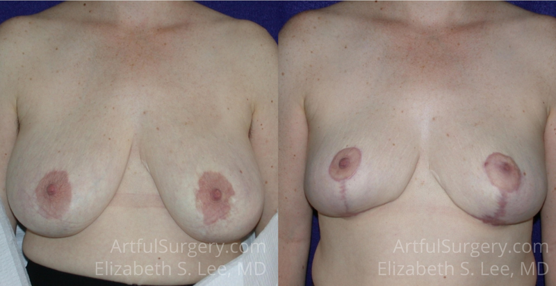 Picture of Breast Reduction-5