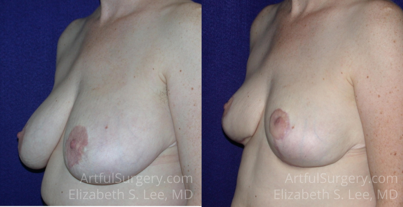 Picture of Breast Reduction-5a