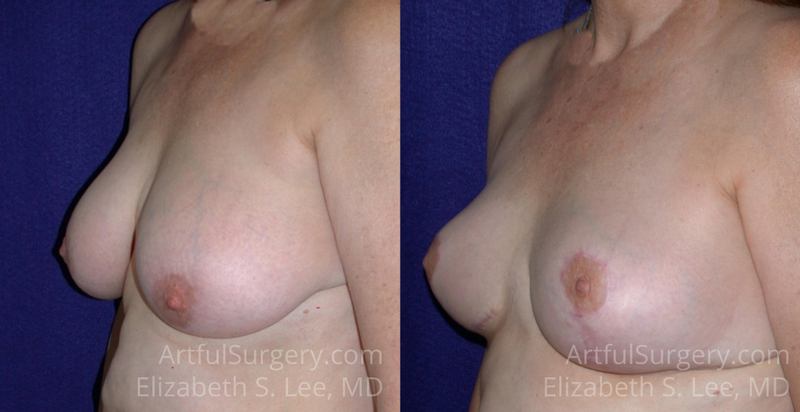 Picture of Breast Reduction-6a