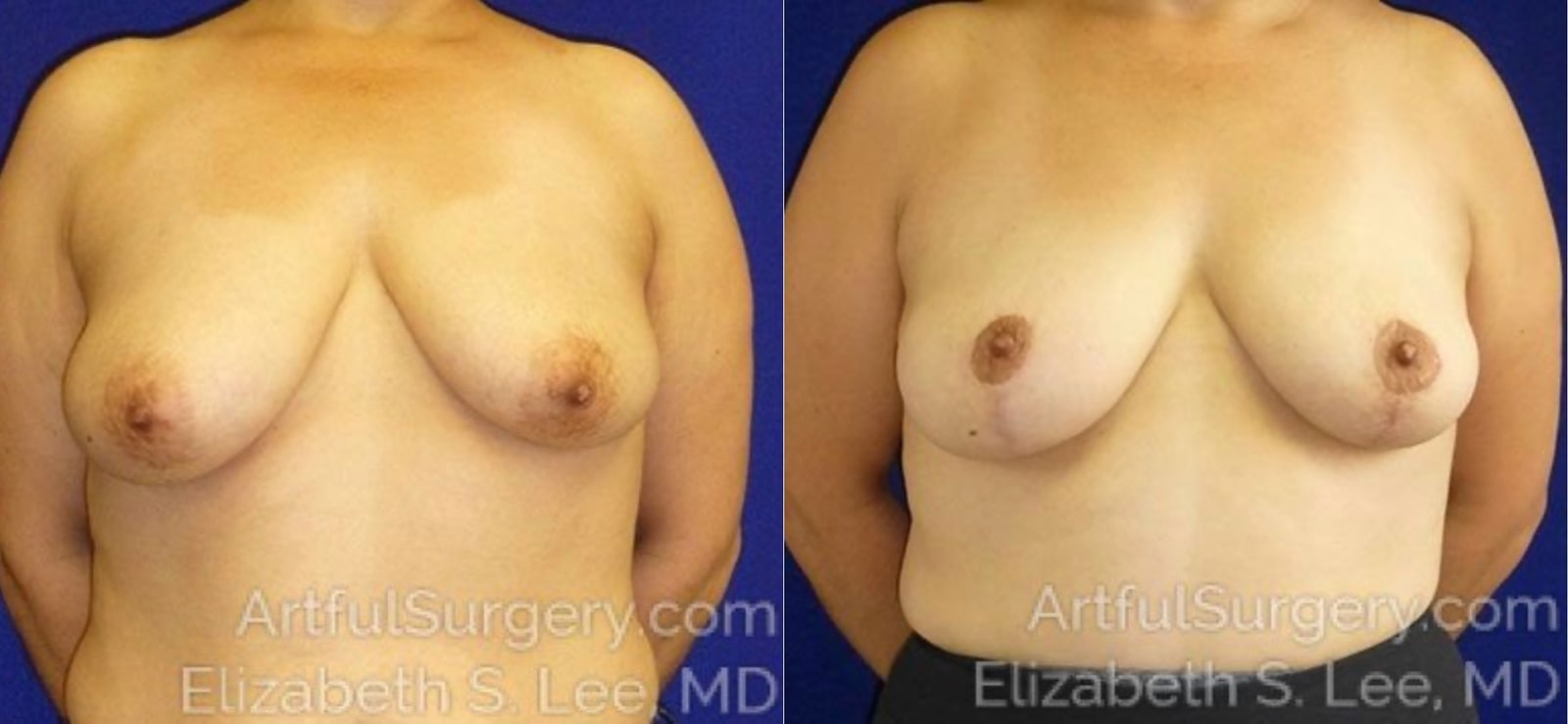 Picture of Breast Augmentation-1