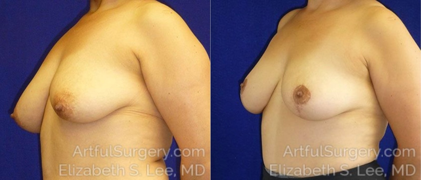Picture of Breast Reduction-7a