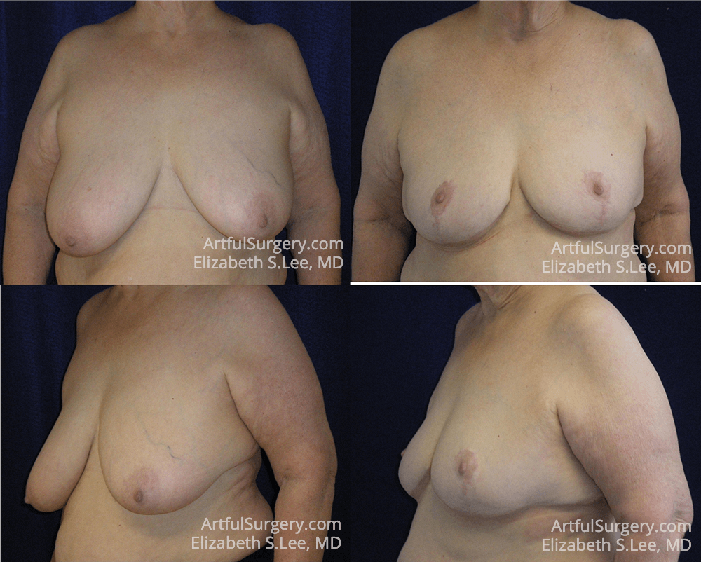 Picture of Breast Reduction-8