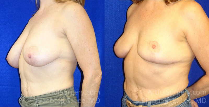 Picture of Breast Reduction-9a