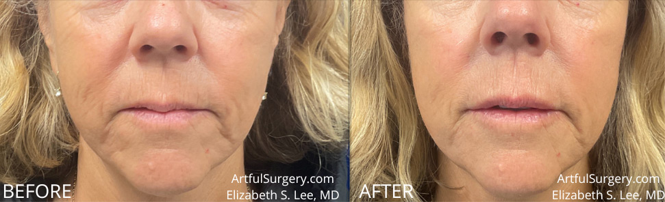 Picture of RHA Lip Filler
