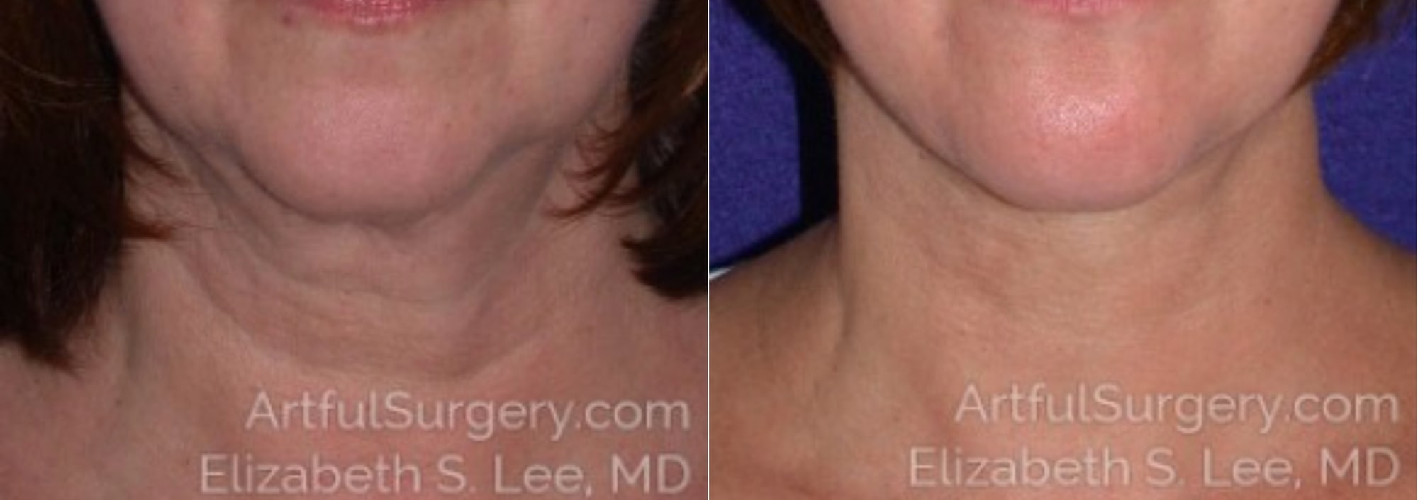 Picture of Neck Lift-01
