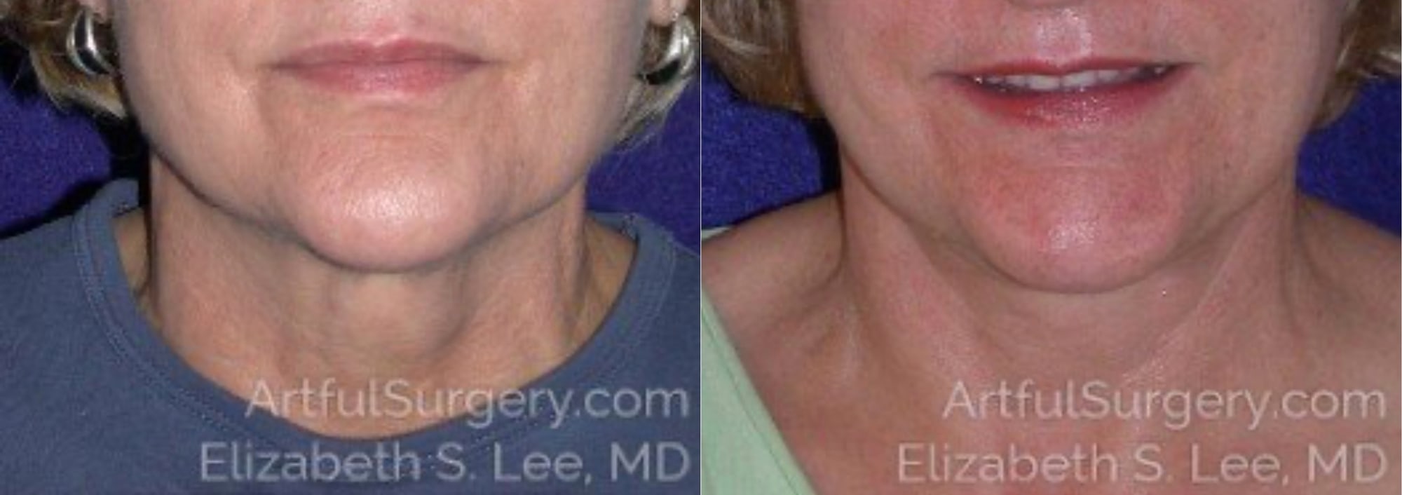 Picture of Neck Lift-09