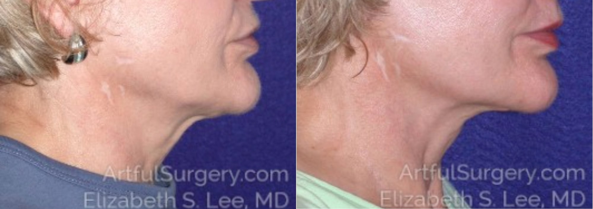 Picture of Neck Lift-09A