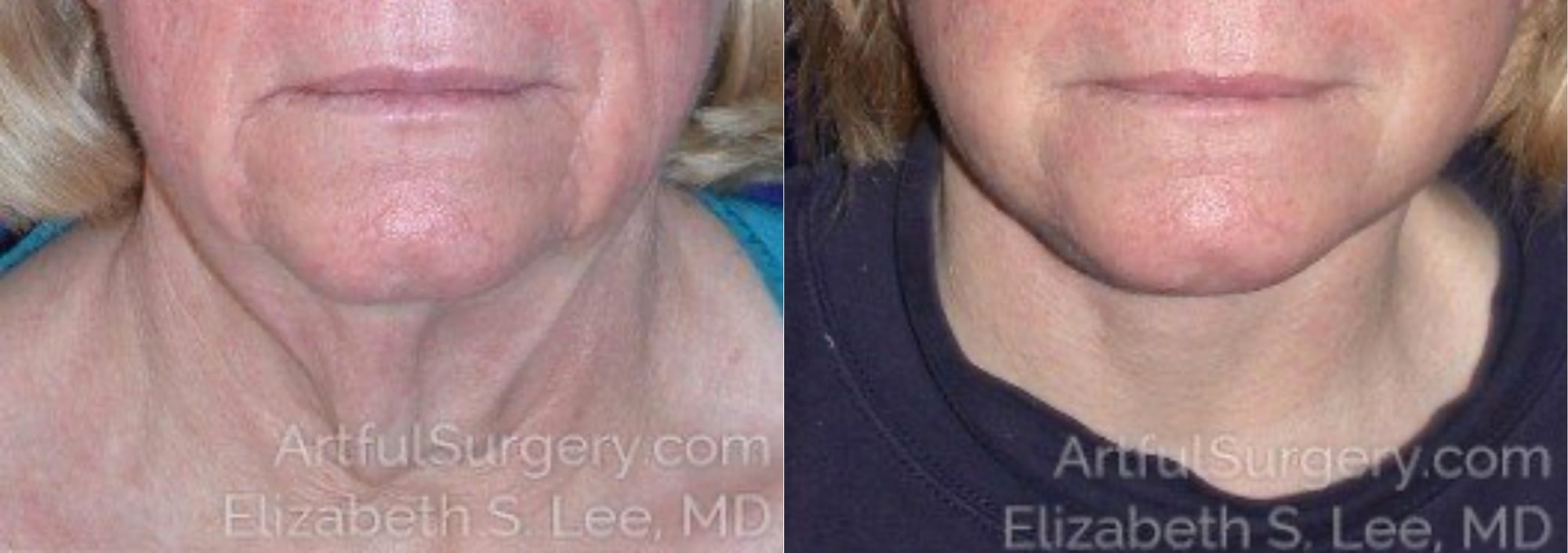 Picture of Neck Lift-11