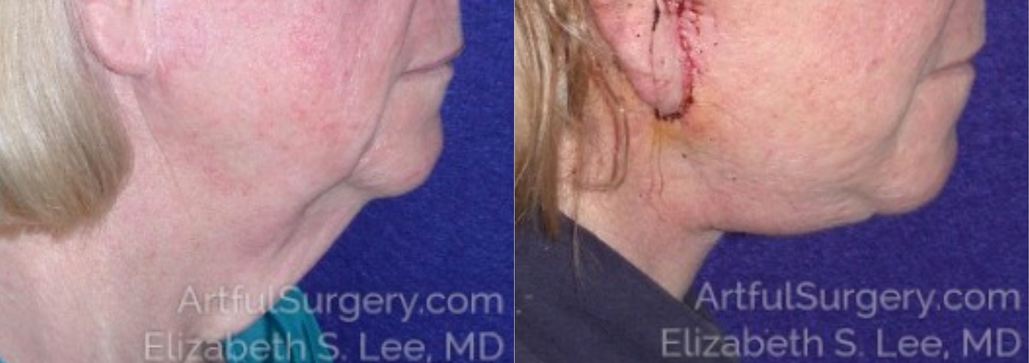 Picture of Neck Lift-11A