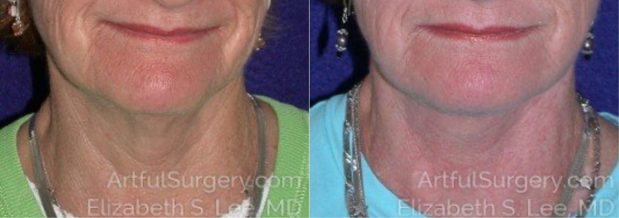 Picture of Neck Lift-12