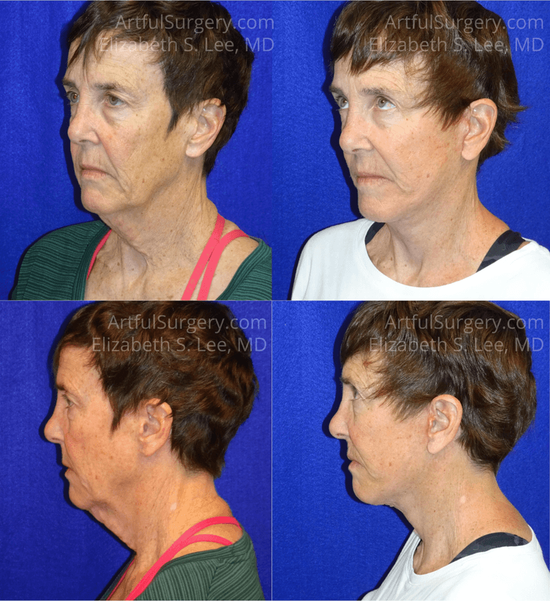 Picture of Neck Lift-13