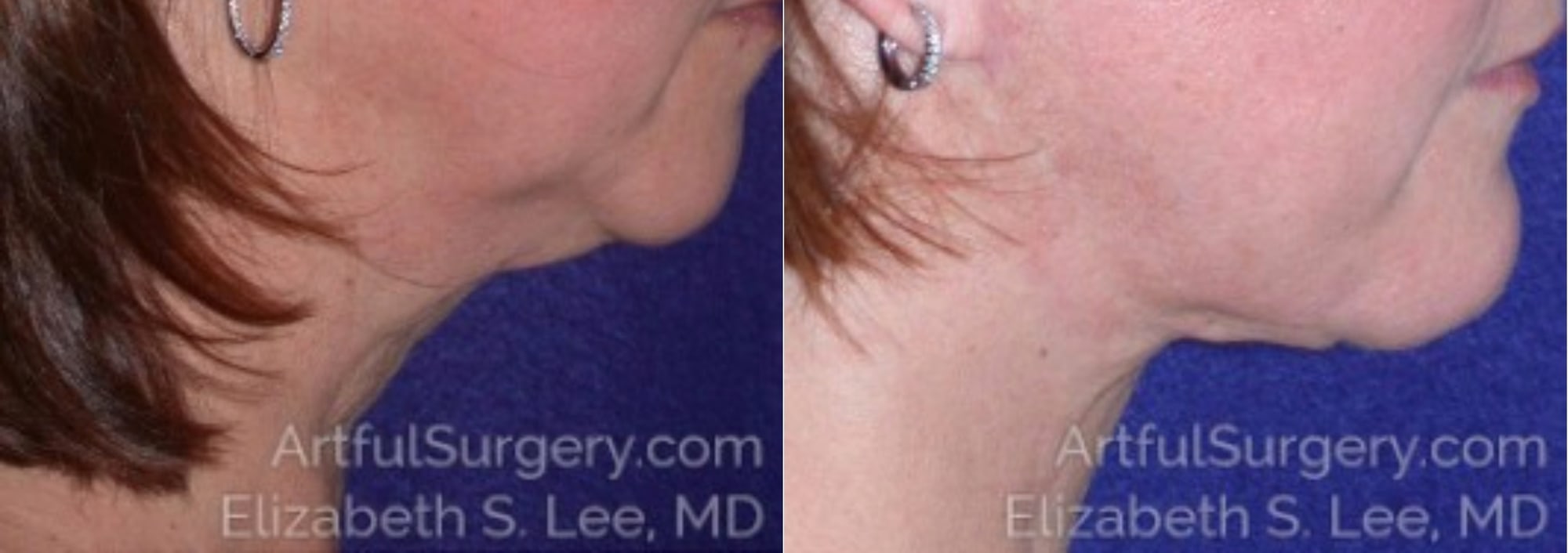 Picture of Neck Lift-01A