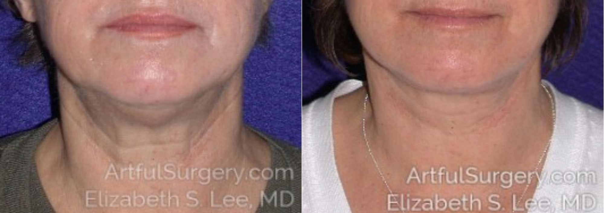 Picture of Neck Lift-02