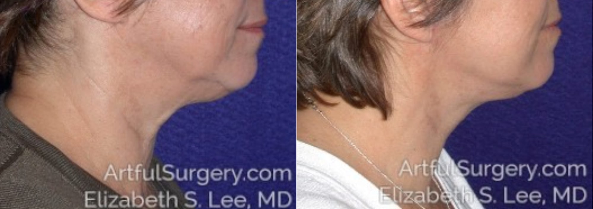 Picture of Neck Lift-02A