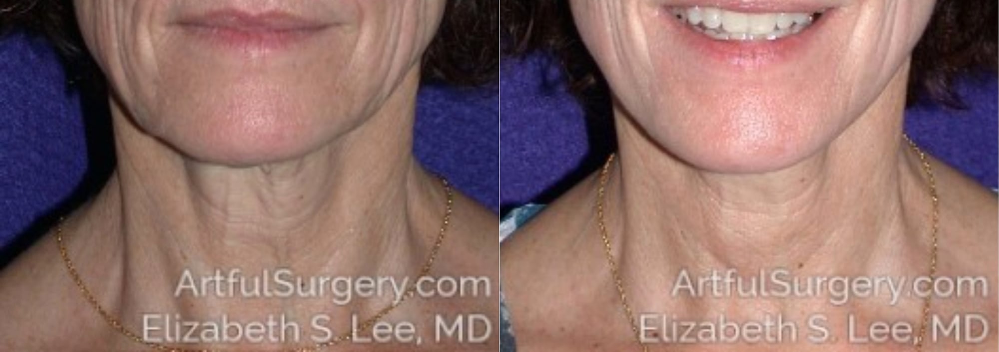 Picture of Neck Lift-03