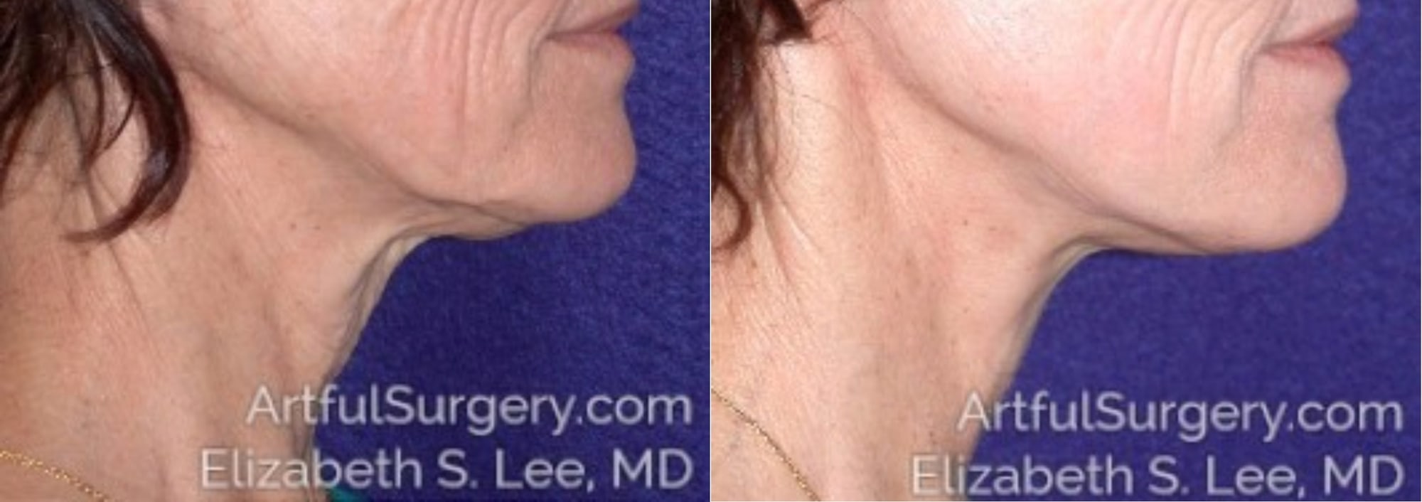 Picture of Neck Lift-03A