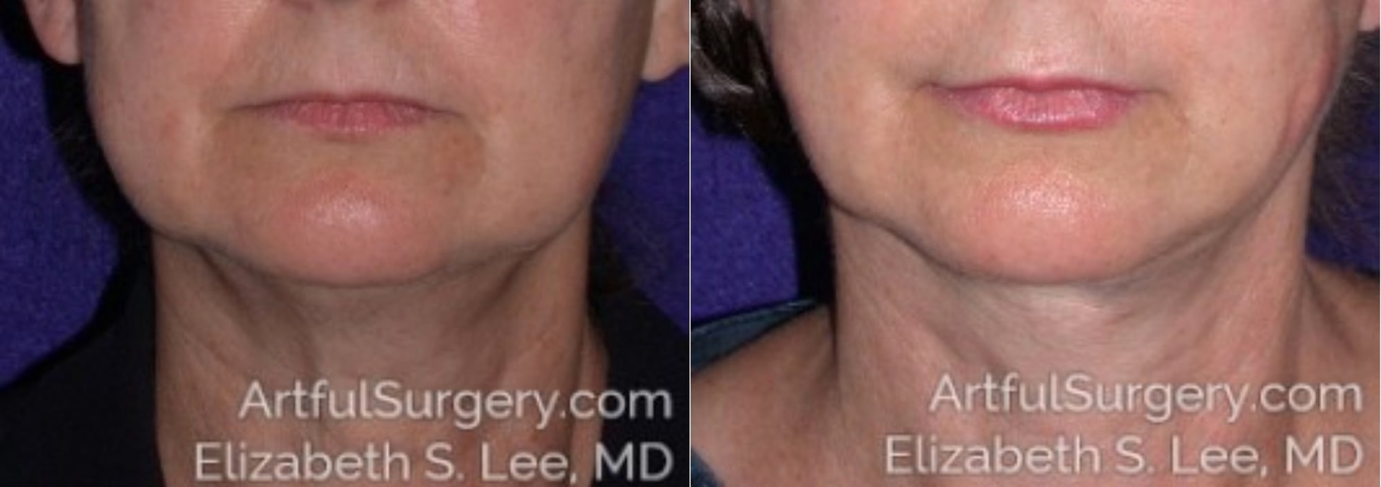 Picture of Neck Lift-04