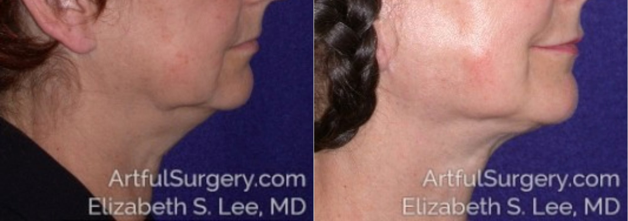 Picture of Neck Lift-04A