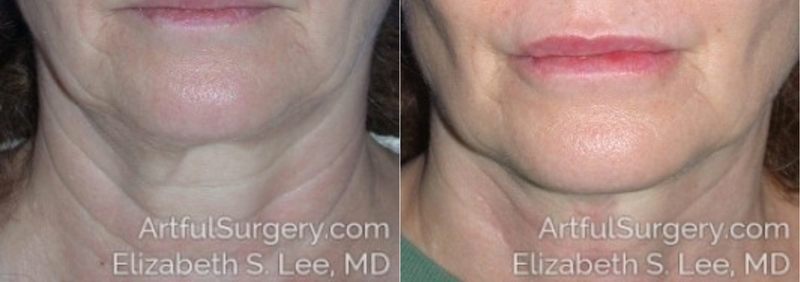 Picture of Neck Lift-05
