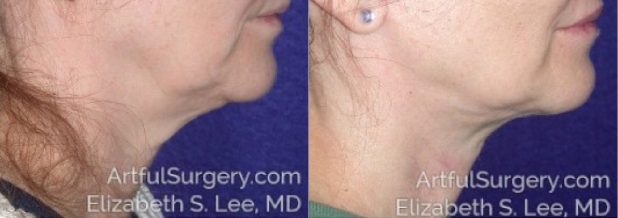 Picture of Neck Lift-05A