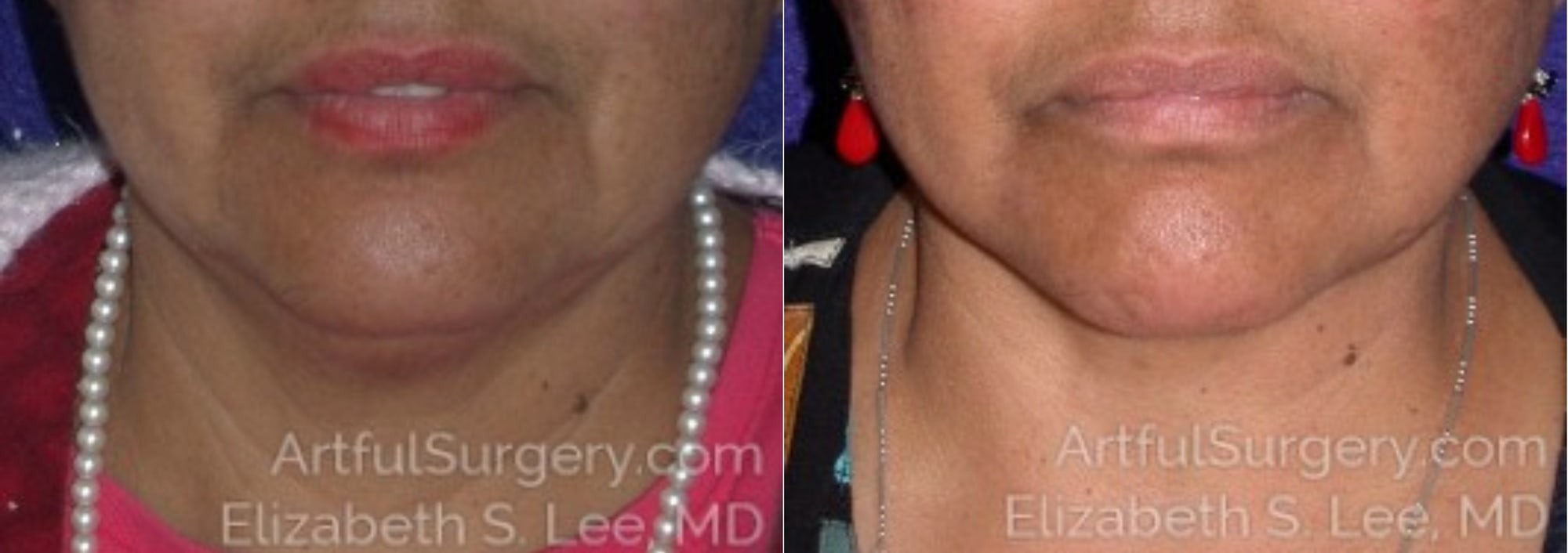 Picture of Neck Lift-07