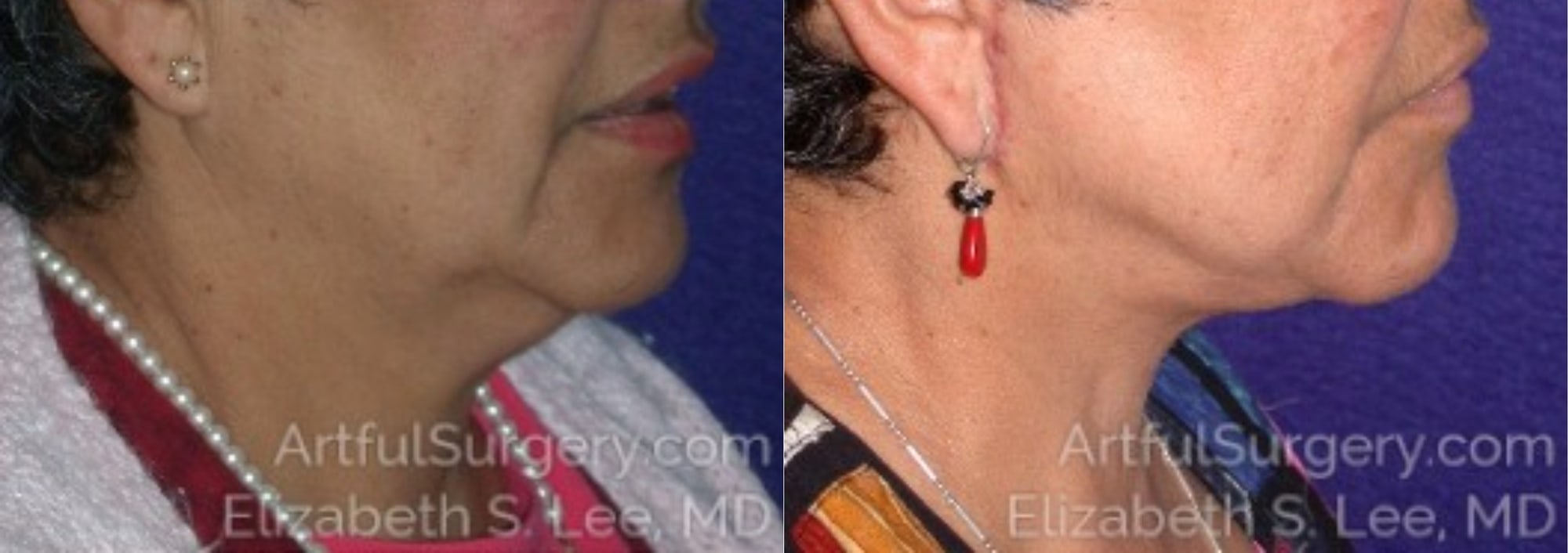 Picture of Neck Lift-07A