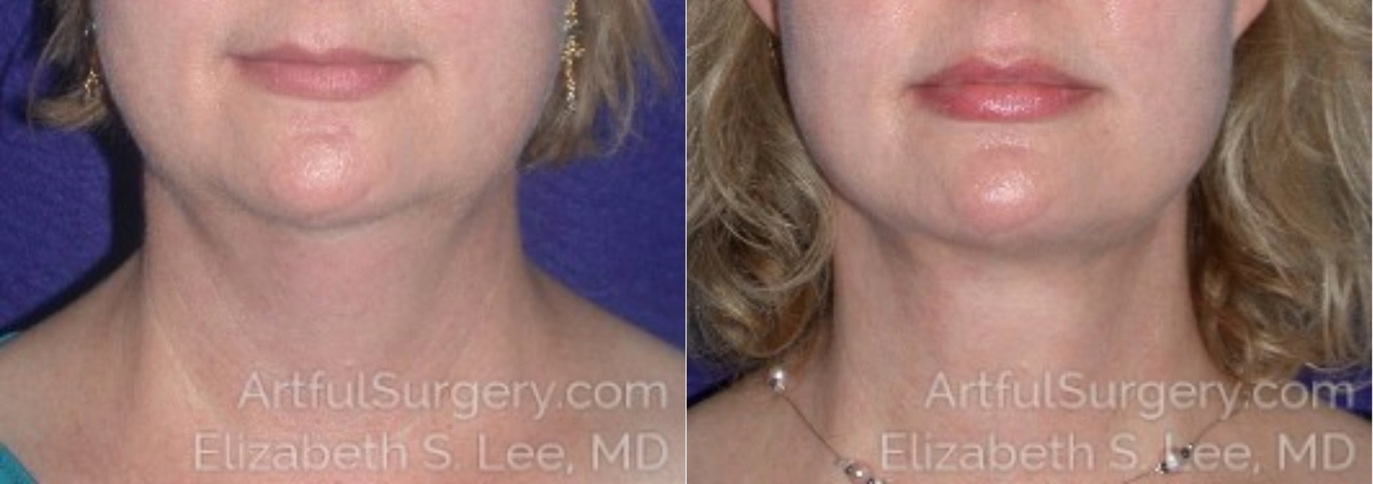 Picture of Neck Lift-08