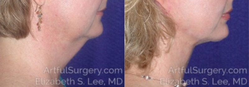 Picture of Neck Lift-08A