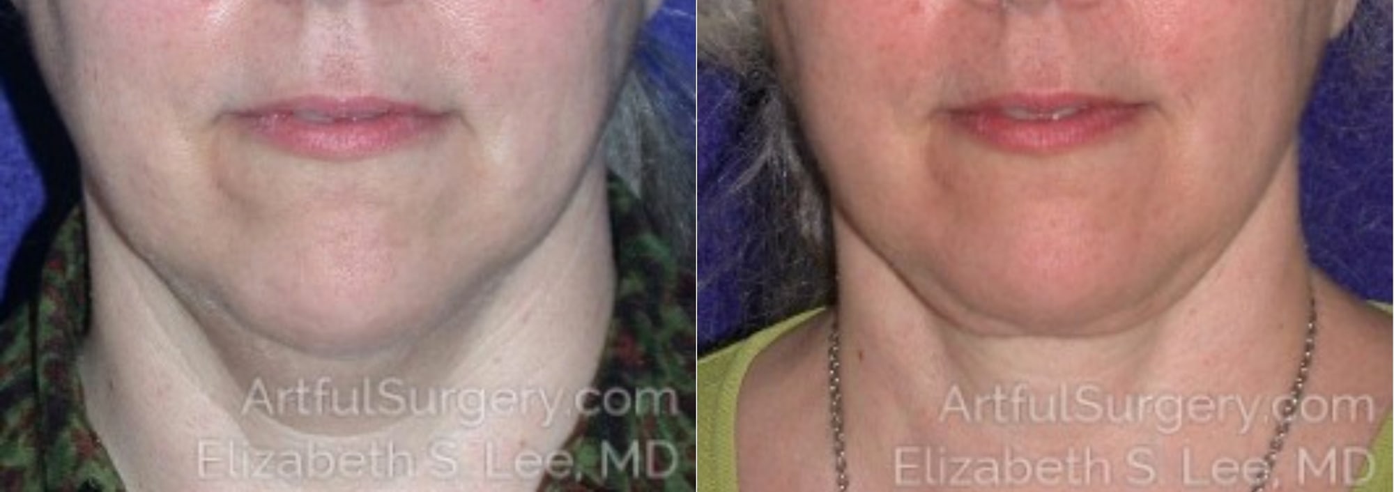 Picture of Neck Lift-09