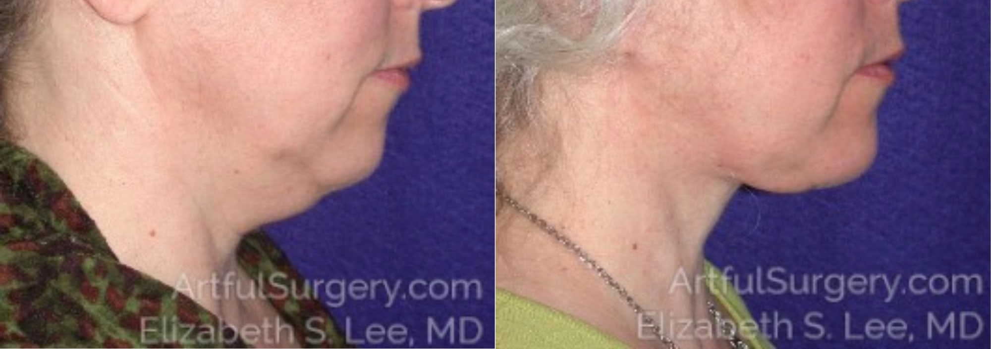 Picture of Neck Lift-09A