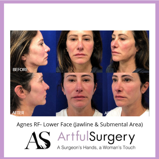 Picture of About Agnes Lower Face and Submental