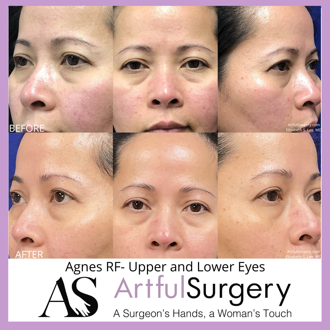 Picture of About Agnes Upper Lower Eyes