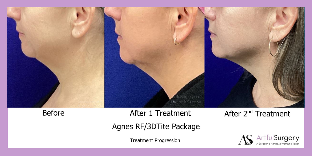 Picture of About Agnes RF/3D Tite Package
