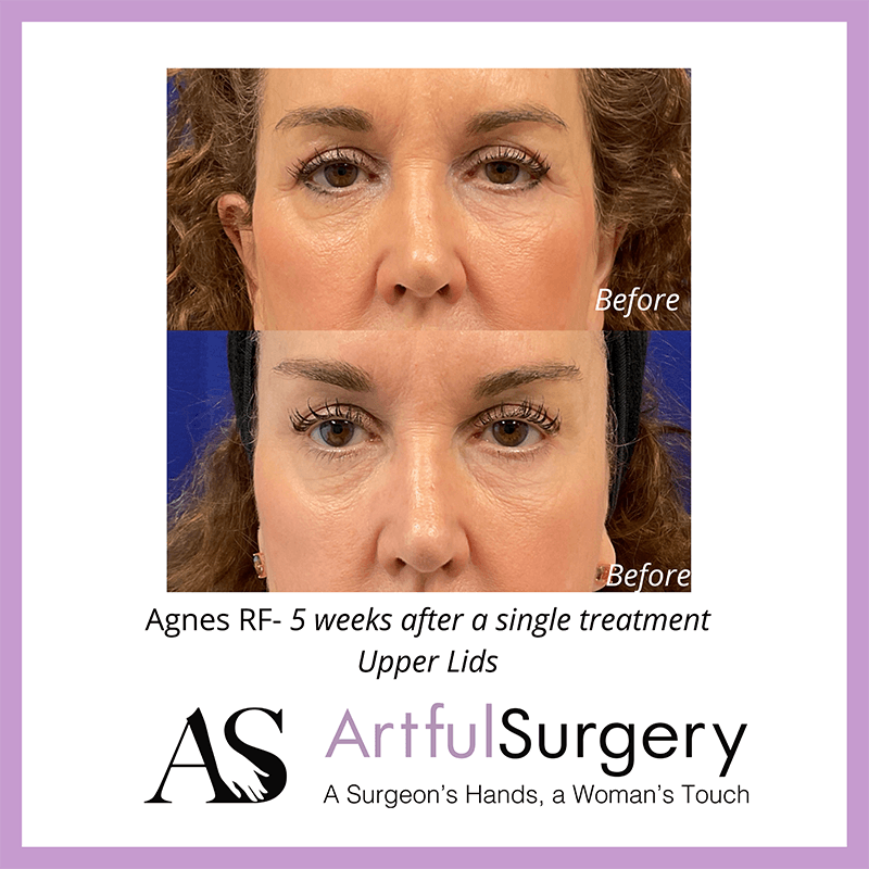 Picture of About Agnes RF