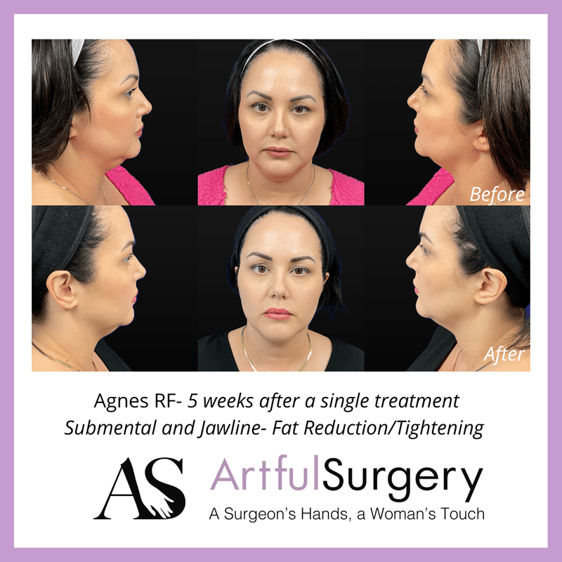 Picture of About Agnes RF