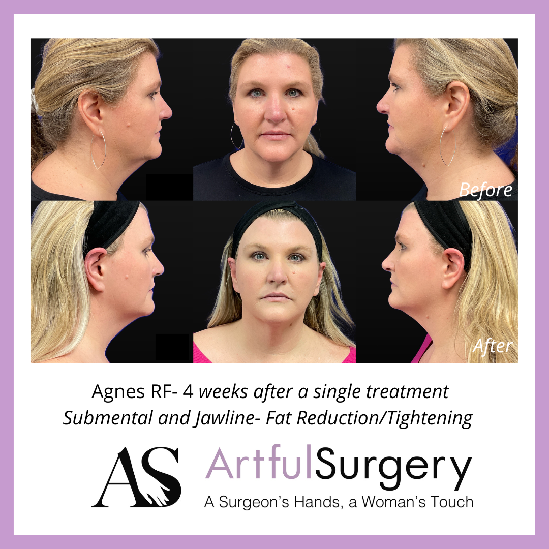 Picture of About Agnes RF