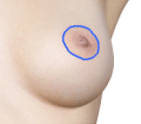 periareolar lift technique