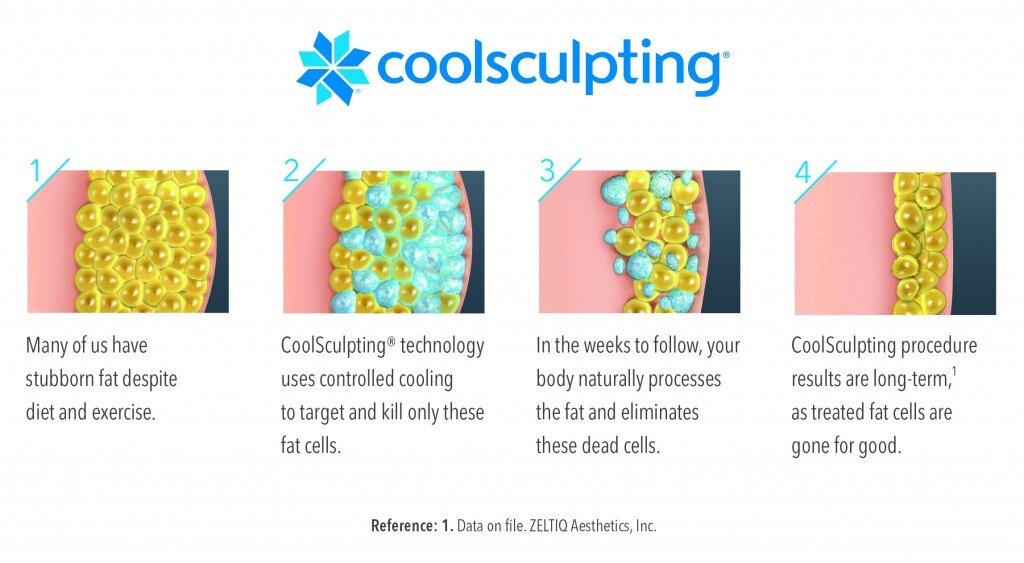 Picture of CoolSculpting2