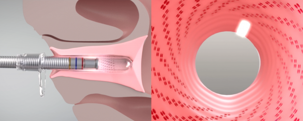 Picture of what is diva laser vaginal therapy