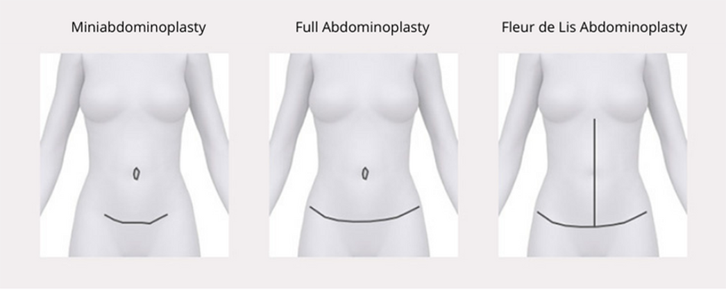 Picture of Types of Abdominoplasty